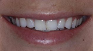 Teeth Treatments - Smile Virtual Before Face