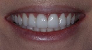 Teeth Treatments - Smile Virtual After Face