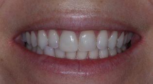 Teeth Treatments - Smile Virtual Before Face