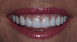 Teeth Treatments - Smile Virtual After Face