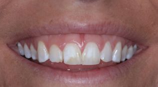 Teeth Treatments - Smile Virtual Before Face