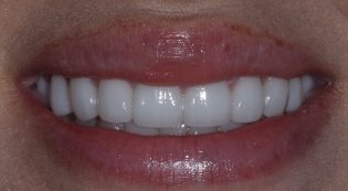 Teeth Treatments - Smile Virtual After Face