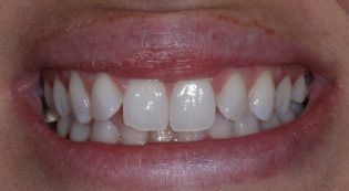 Teeth Treatments - Smile Virtual Before Face