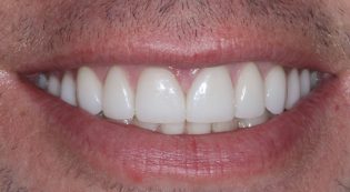 Teeth Treatments - Smile Virtual After Face