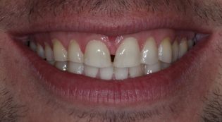Teeth Treatments - Smile Virtual Before Face