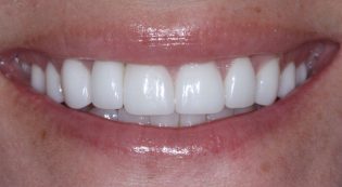 Teeth Treatments - Smile Virtual After Face