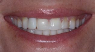 Teeth Treatments - Smile Virtual Before Face