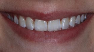 Teeth Treatments - Smile Virtual Before Face