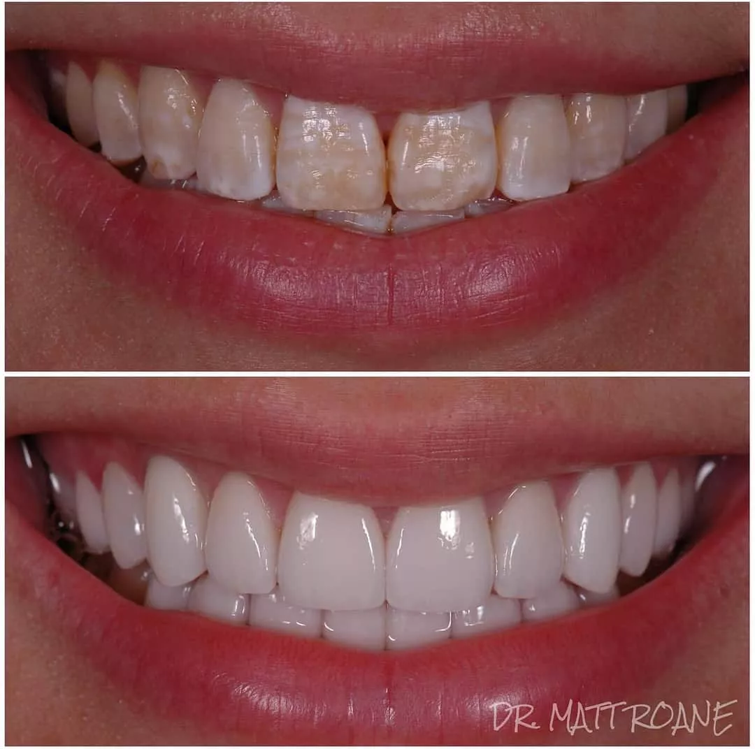Smile Transformation by Smile virtual