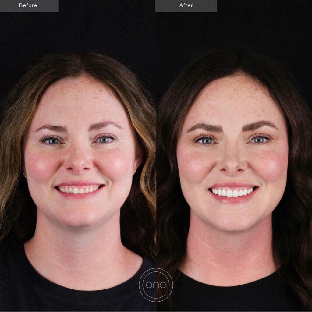 Dental Crowns By Smile Virtual