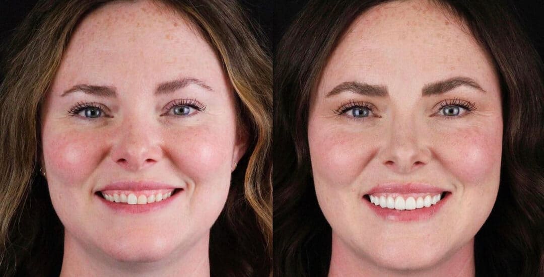 Dental Crowns By Smile Virtual