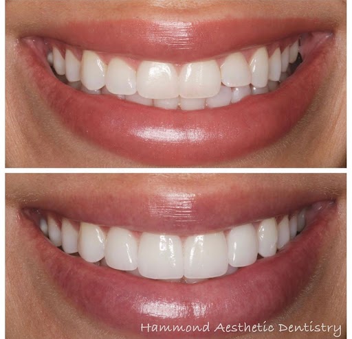 Retainers vs Aligners By Smile Virtual