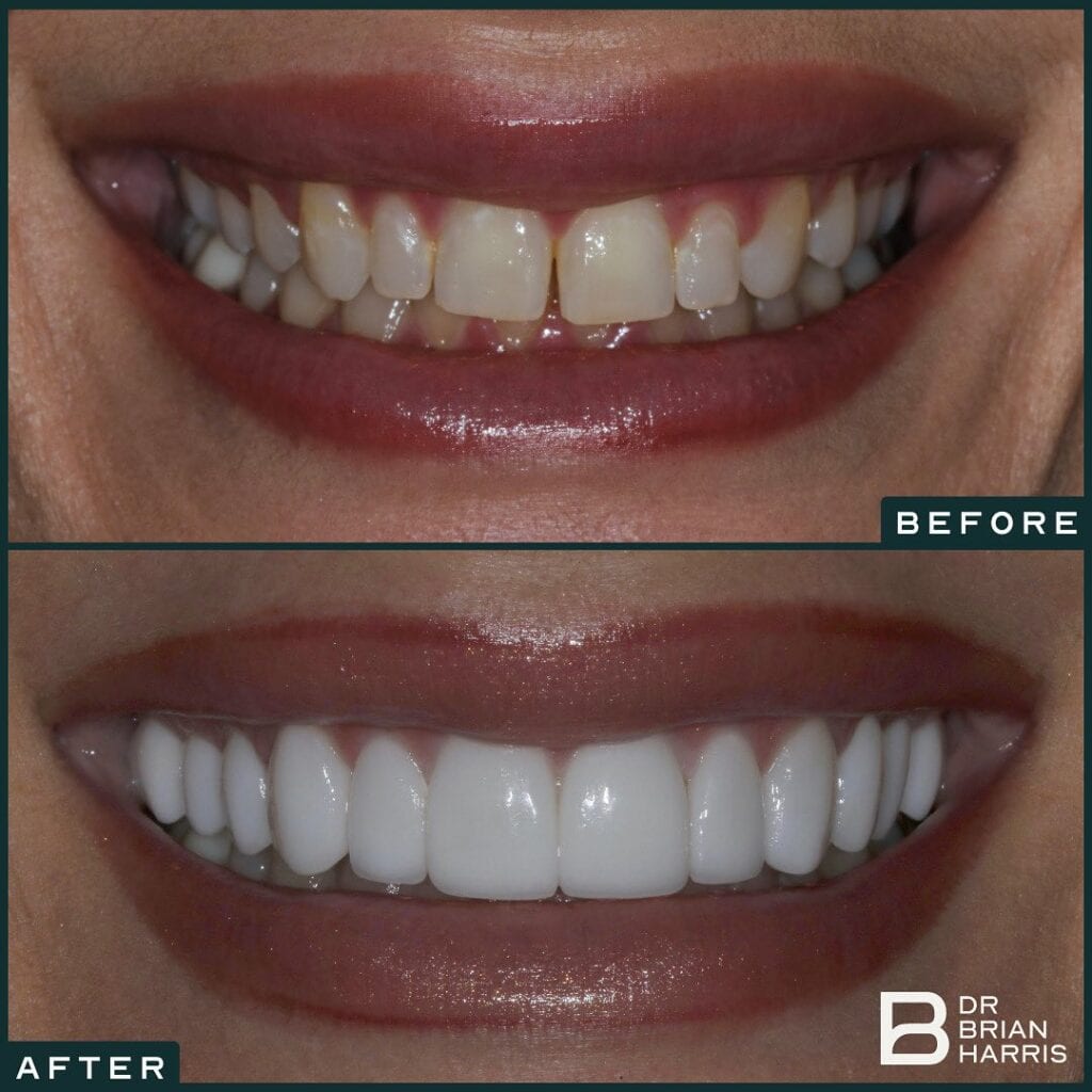 Teeth Whitening By Smile Virtual