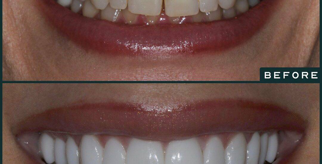 Teeth Whitening By Smile Virtual