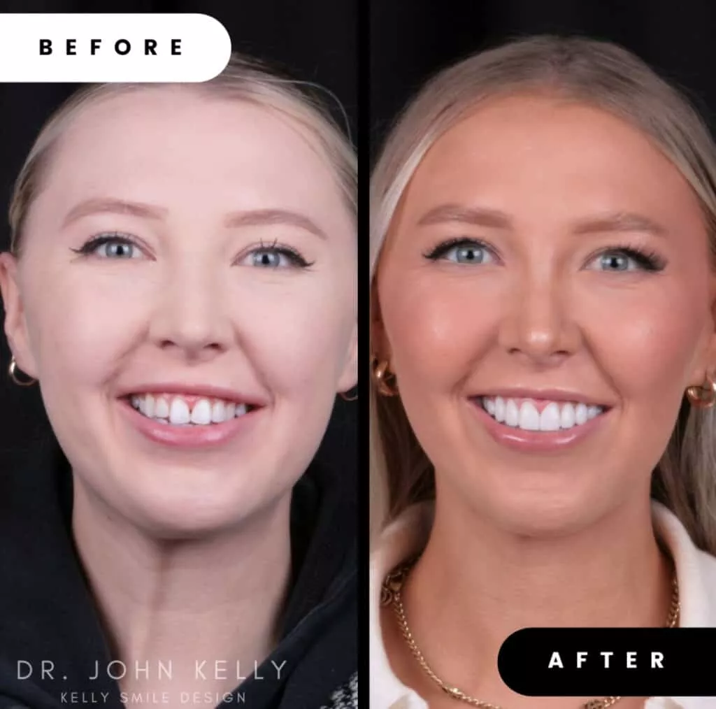 Veneers by Smile Virtual