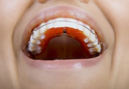 dental-retainer