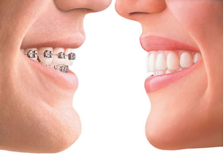 invisalign-vs-braces