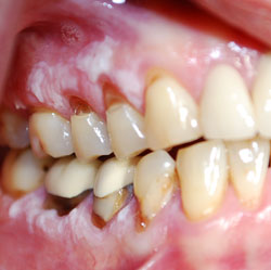 oral-cancer1
