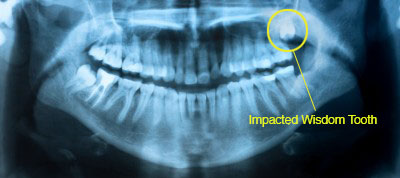 wisdom-teeth