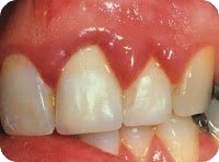 bleeding-gums