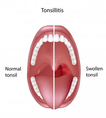 tonsillitis
